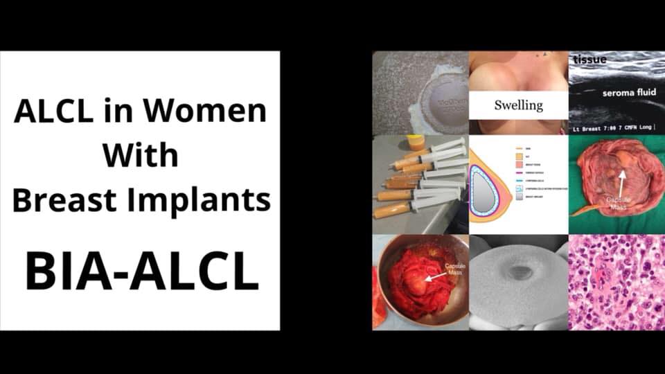 ALCL in women with breast implants